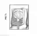 Fig. 22 - THREADED BONE FILLING MATERIAL PLUNGER