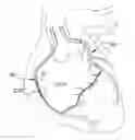 Fig. 01 - Medical Device for Revascularization of Vascular Occlusion and Method for Using Same