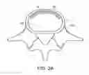 Fig. 03 - In-situ formed intervertebral fusion device and method