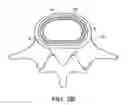 Fig. 04 - In-situ formed intervertebral fusion device and method