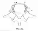 Fig. 05 - In-situ formed intervertebral fusion device and method