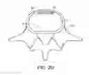 Fig. 06 - In-situ formed intervertebral fusion device and method