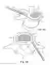 Fig. 11 - In-situ formed intervertebral fusion device and method