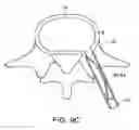Fig. 16 - In-situ formed intervertebral fusion device and method