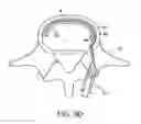 Fig. 17 - In-situ formed intervertebral fusion device and method