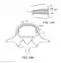 Fig. 18 - In-situ formed intervertebral fusion device and method