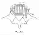 Fig. 23 - In-situ formed intervertebral fusion device and method