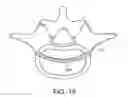 Fig. 27 - In-situ formed intervertebral fusion device and method