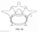 Fig. 28 - In-situ formed intervertebral fusion device and method