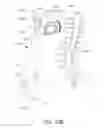 Fig. 97 - Adjustable implant and method of use
