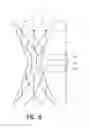 Fig. 06 - Bypass device, support frame for bypass device, and method