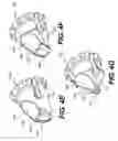 Fig. 06 - Non-invasive devices and methods for lowering intra-ocular pressure