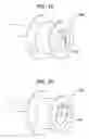 Fig. 08 - Tympanic membrane pressure equalization tube