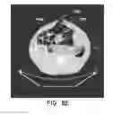 Fig. 19 - Negative pressure wound closure device