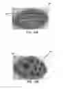 Fig. 22 - Negative pressure wound closure device