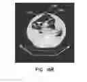 Fig. 30 - Negative pressure wound closure device