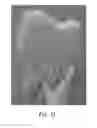 Fig. 71 - Negative pressure wound closure device