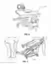 Fig. 04 - Lower extremity positioning assembly and table extension
