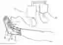 Fig. 01 - Device and method for prevention and treatment of deep venous thrombosis