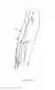Fig. 02 - Device and method for prevention and treatment of deep venous thrombosis
