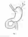 Fig. 02 - Device, kit and method for placing jejunal tube device through stomach and into small intestine related application