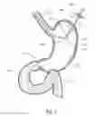 Fig. 04 - Device, kit and method for placing jejunal tube device through stomach and into small intestine related application