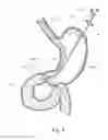 Fig. 05 - Device, kit and method for placing jejunal tube device through stomach and into small intestine related application
