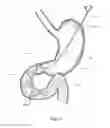 Fig. 07 - Device, kit and method for placing jejunal tube device through stomach and into small intestine related application