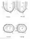 Fig. 04 - Biphasic and dynamic adjustable support devices and methods with assist and recoil capabilities for treatment of cardiac pathologies