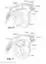 Fig. 08 - Balloon catheter with fluid injection elements