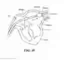 Fig. 09 - Balloon catheter with fluid injection elements