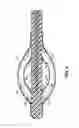 Fig. 06 - CATHETER BASED BALLOON FOR THERAPY MODIFICATION AND POSITIONING OF TISSUE