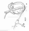 Fig. 06 - EPICARDIAL LEAD PLACEMENT APPARATUS, SYSTEMS, AND METHODS