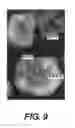 Fig. 09 - METHODS, PROBE SETS, AND KITS FOR DETECTION OF DELETION OF TUMOR SUPPRESSOR GENES BY FLUORESCENCE IN SITU HYBRIDIZATION