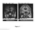Fig. 02 - ALZHEIMER'S DISEASE DIAGNOSTIC PANELS AND METHODS FOR THEIR USE