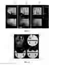 Fig. 07 - Apparatuses and methods for cancellation of inhomogeneous magnetic fields induced by non-biological materials within a patient's mouth during magnetic resonance imaging