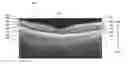 Fig. 01 - Geographic atrophy identification and measurement