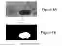 Fig. 13 - Geographic atrophy identification and measurement