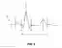 Fig. 04 - Prediction of cardiac resynchronization therapy response based on variability of repolarization