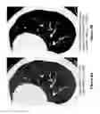 Fig. 05 - Supervised machine learning technique for reduction of radiation dose in computed tomography imaging