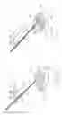 Fig. 45 - Pneumoperitoneum device