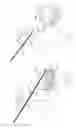 Fig. 46 - Pneumoperitoneum device