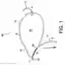 Fig. 02 - Knotless tensionable suture construct for tissue reattachment