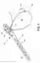 Fig. 07 - Knotless tensionable suture construct for tissue reattachment