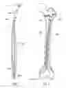 Fig. 02 - Intramedullary pin