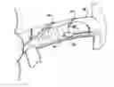 Fig. 01 - Renal denervation system