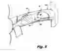 Fig. 09 - Renal denervation system