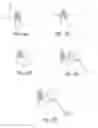 Fig. 09 - Post nasal drip treatment