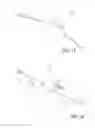 Fig. 17 - Post nasal drip treatment