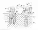 Fig. 01 - Dental bridge